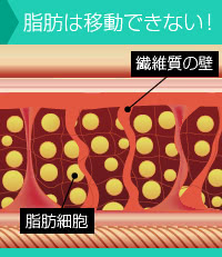 脇肉の脂肪は「矯正下着」で移動しない
