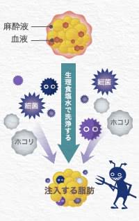 脂肪注入豊胸で感染症が起こる原因
