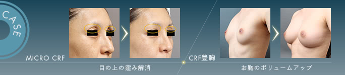 脂肪注入による施術の症例