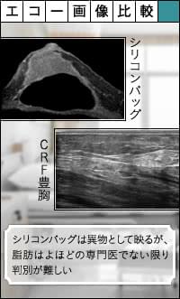 シリコンバッグとコンデンスリッチ豊胸のエコー画像比較