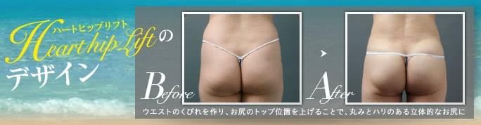 ハートヒップリフトで四角いお尻を改善した症例