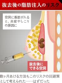 シリコンバッグ抜去後の脂肪注入のリスク