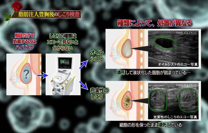 脂肪注入豊胸のしこりの種類