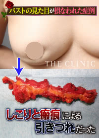 脂肪注入豊胸のしこりによってバストの見た目が損なわれた症例