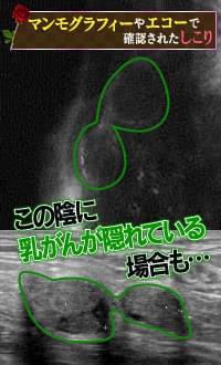 脂肪注入豊胸のしこりは、乳がんの早期発見を妨げる