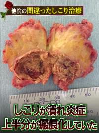 脂肪注入豊胸のしこりは炎症や皮膚障害のリスクを招く