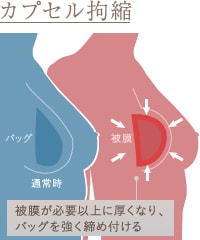 カプセル拘縮は被膜が厚くなり、バッグを締め付ける