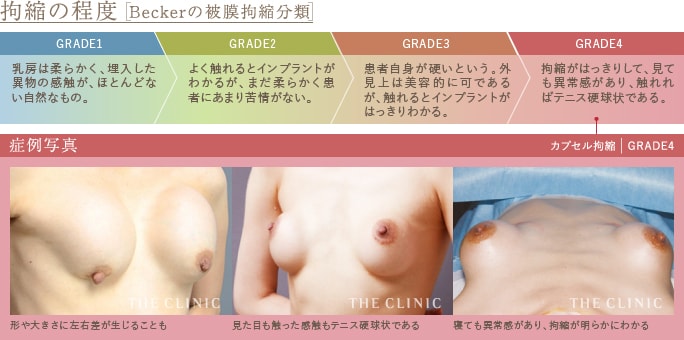カプセル拘縮のレベル表