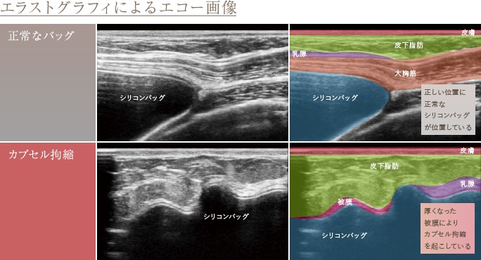 エラストグラフィーによるエコー画像