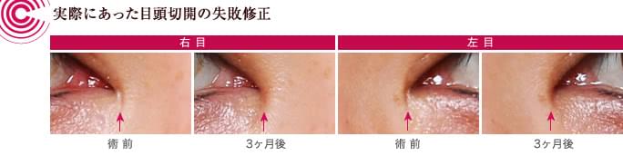 目頭切開の失敗を修正した前後の写真