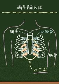 漏斗胸とは