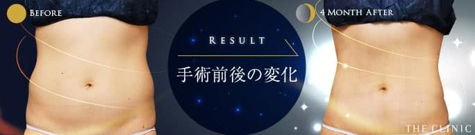 お腹の脂肪吸引、手術前後の変化