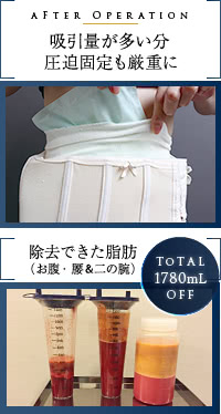 お腹・腰・二の腕から除去した脂肪