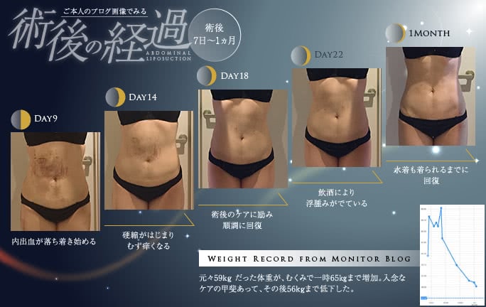 脂肪吸引のブログ画像でみる術後7日〜1ヵ月