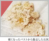 硬くなったバストから除去した石灰