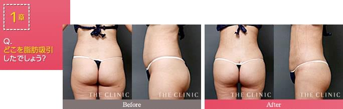 腰と太ももの脂肪吸引症例