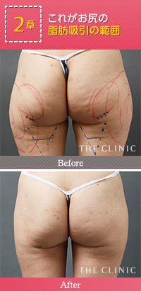 お尻の脂肪吸引の範囲
