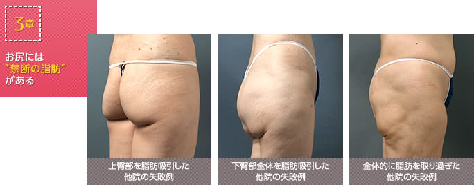 お尻の脂肪吸引の他院失敗例