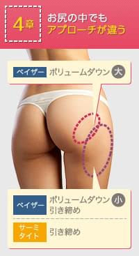 お尻の脂肪吸引でアプローチすべき部分