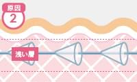 表皮に糸を入れた場合