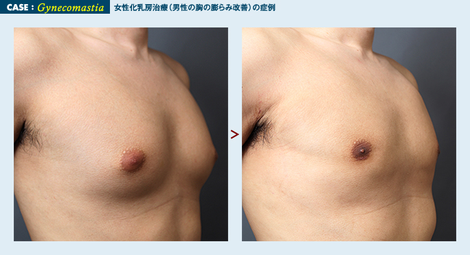 胸部のベイザー脂肪吸引の症例