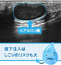 ヒアルロン酸の注入場所