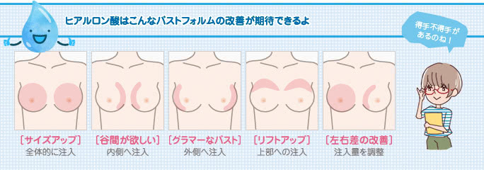 ヒアルロン酸豊胸で改善できるお悩み例