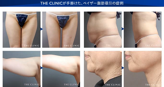 THE CLINIC が手掛けたベイザー脂肪吸引の症例