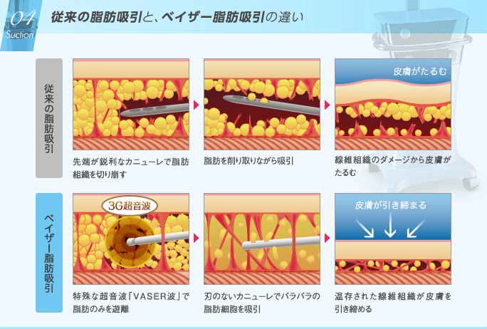 従来の脂肪吸引と、ベイザー脂肪吸引の違い