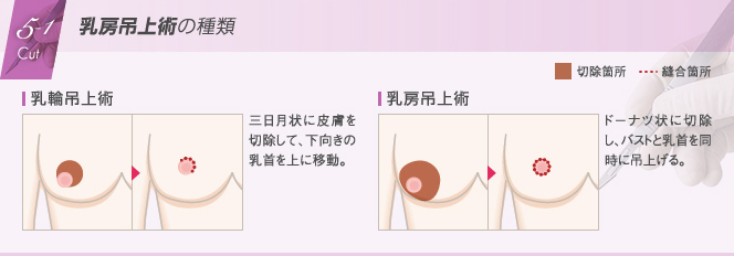 乳房吊上術の種類