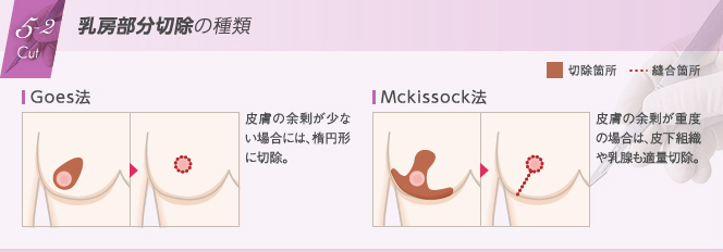 乳房部分切除の種類