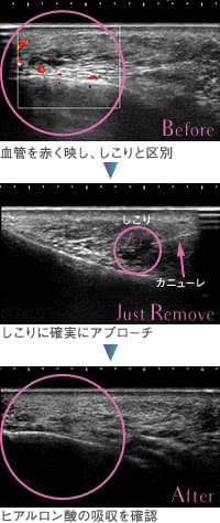 ヒアルロン酸を除去しているときのエコー写真