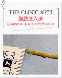 THE CLINIC が行う脂肪注入法（2.4mmヌードルインジェクション）