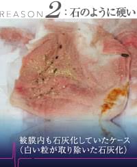 豊胸シリコンバッグと同時に除去した石灰化
