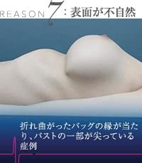 豊胸シリコンバッグのリップリング症例