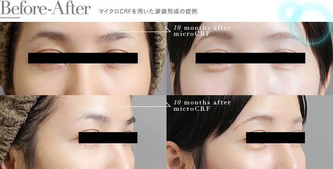 脂肪注入による涙袋の整形