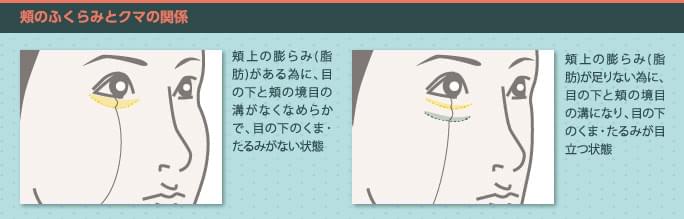 頬のふくらみとクマの関係
