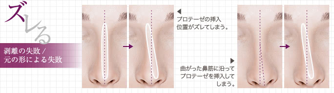 鼻プロテーゼの失敗でよくある「ズレ」