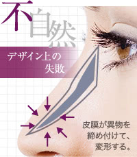 鼻プロテーゼの失敗でよくある「不自然なデザイン」