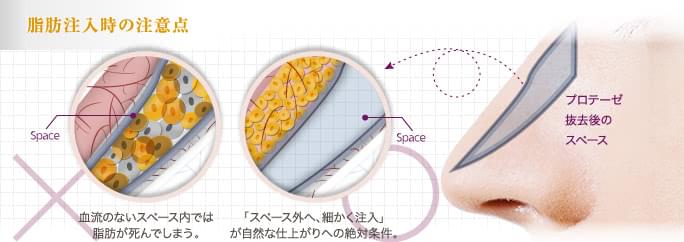 鼻プロテーゼの失敗を脂肪で修正する際の注意点
