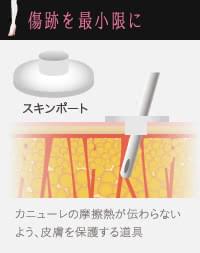 脂肪吸引後の傷跡を残さないスキンポートとは