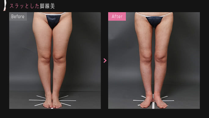 理想の脚線美を脂肪吸引で手に入れた例