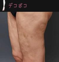 太もも・ふくらはぎの脂肪吸引の失敗例:凸凹