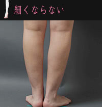 ふくらはぎの脂肪吸引の失敗例:効果がない