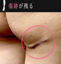 足の脂肪吸引の失敗例:傷跡が残る