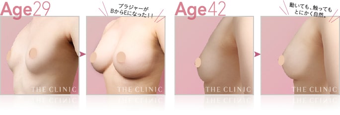 美・バスト豊胸モニターの症例写真