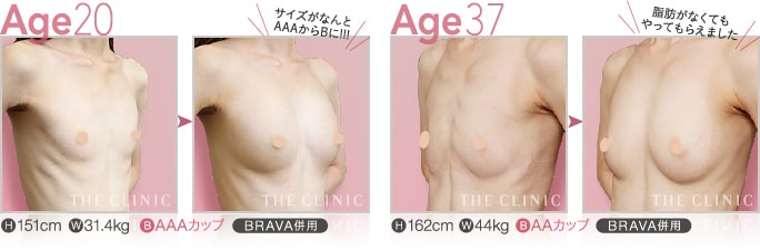 痩せ型（AA・AAAカップ）豊胸モニターの症例写真