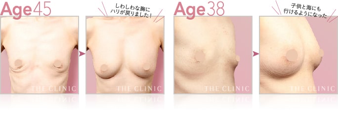 授乳後豊胸モニターの症例写真