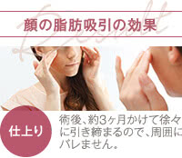顔の脂肪吸引で効果を実感するまでの期間