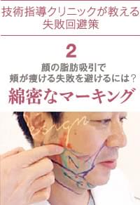 顔の脂肪吸引の失敗回避策2:マーキング